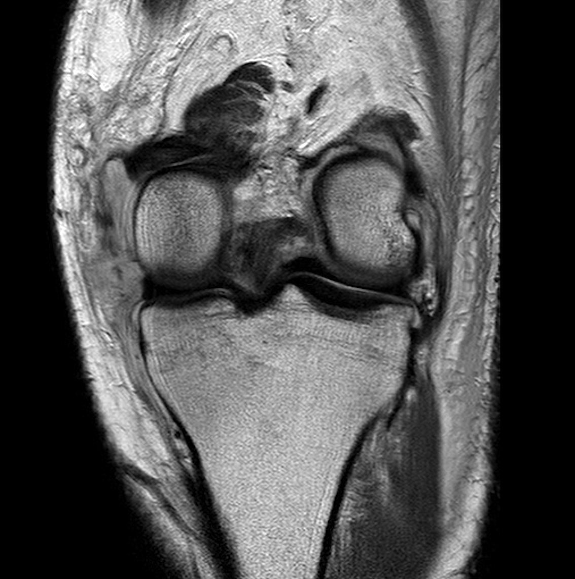 Knee Dislocation ACL PCL MCL MRI 1